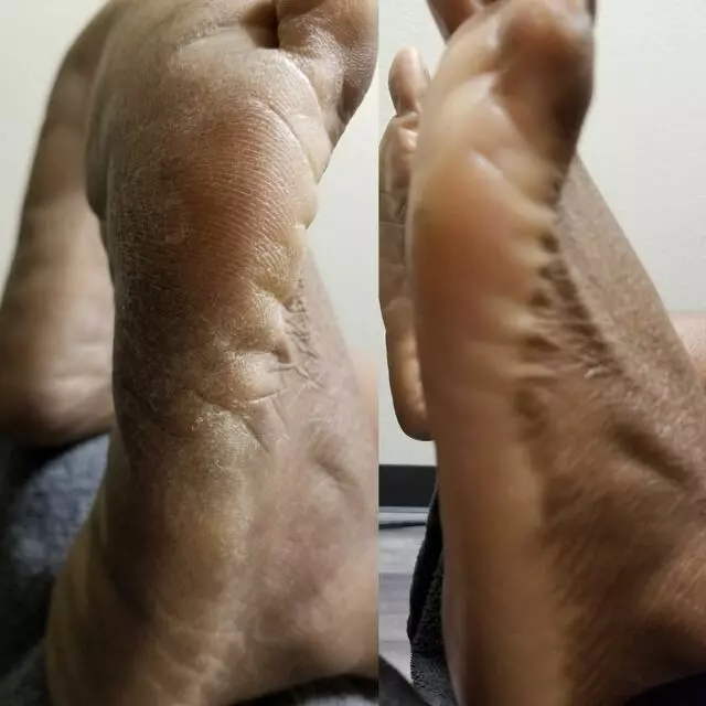 The Callus Queen