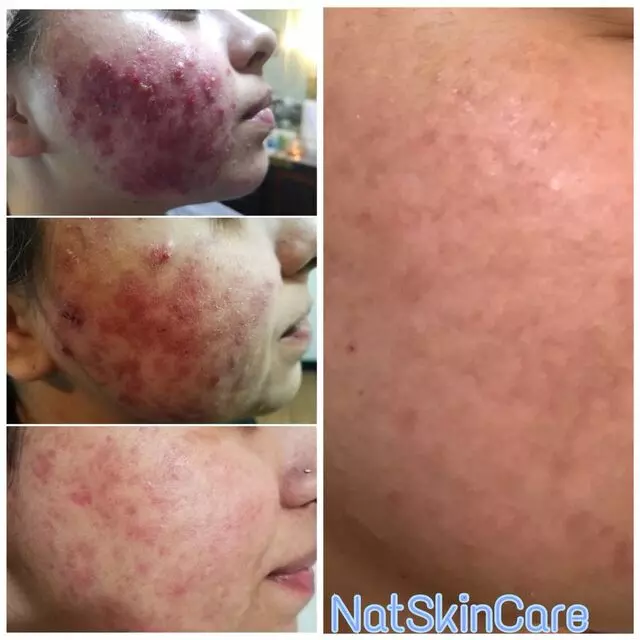NatSkinCare