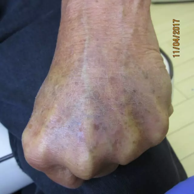 Serenity Tattoo Removal